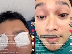 Mata Merah Berhari-hari Dikira COVID, Ternyata Kena Penyakit Ini