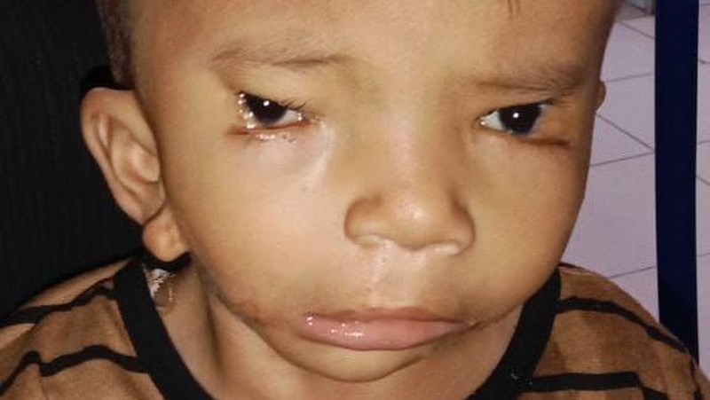 Mari Bantu Afriliam, Bocah 2 Tahun Butuh Operasi Rekonstruksi Wajah