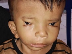 Mari Bantu Afriliam, Bocah 2 Tahun Butuh Operasi Rekonstruksi Wajah