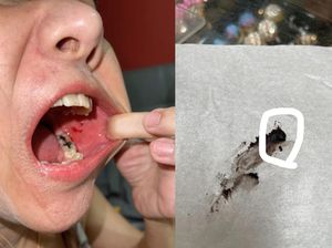 Ngeri! Mulut Wanita Ini Berdarah karena Gigit Potongan Kaca dalam Donat