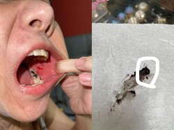 Insiden Donat yang Bikin Mulut Wanita Berdarah