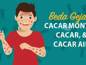 Kenali Perbedaan Gejala Cacar, Cacar Air, dan Cacar Monyet Kenali Perbedaan Gejala Cacar, Cacar Air, dan Cacar Monyet