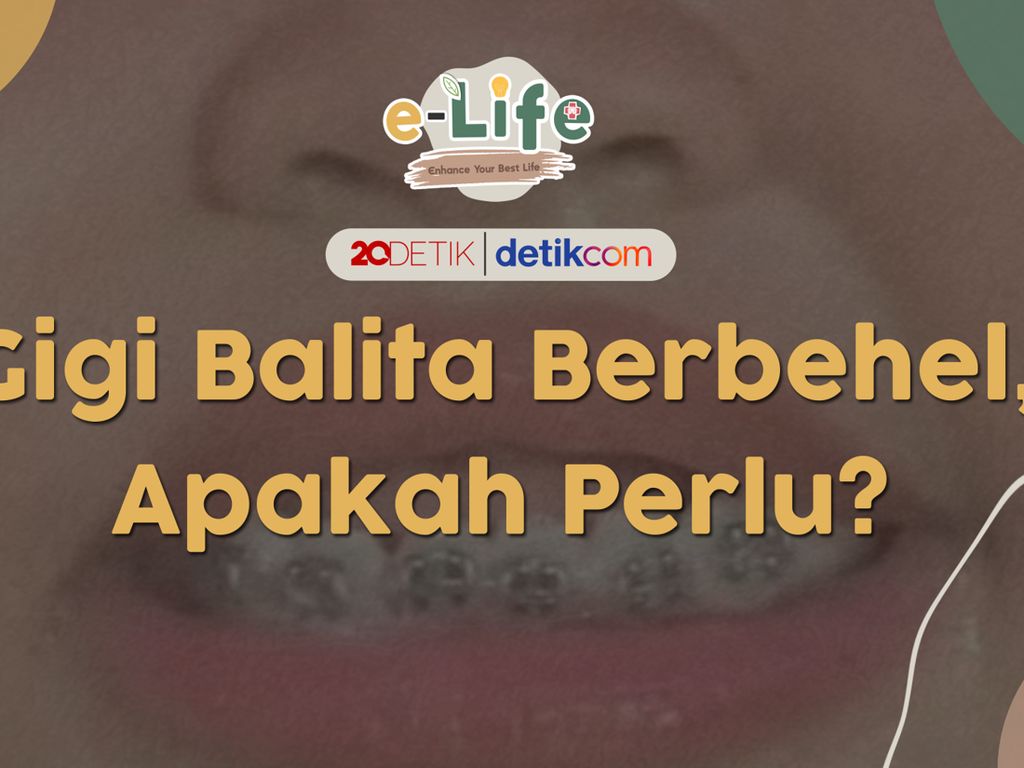 Usia Berapa Sih Anak Boleh Pasang Behel? Usia Berapa Sih Anak Boleh Pasang Behel?