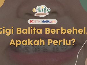 Usia Berapa Sih Anak Boleh Pasang Behel? Usia Berapa Sih Anak Boleh Pasang Behel?