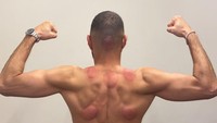 Rahasia bugarnya fisik Benzema pertama adalah terapi bekam atau biasa disebut dalam bahasa Inggris sebagai Cupping therapy. Terapi ini tidak punya efek samping dan dinilai aman untuk menjaga kebugaran tubuh (Instagram/karimbenzema)