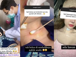 Kondisi Terkini Lucinta Luna Pasca Jahitan Khodam Dibuka