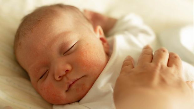 Penyebab dan cara mengobati ruam kulit anak.