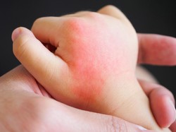 Badan Ruam Merah Tidak Gatal, Apakah Gejala DBD?