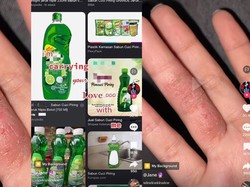 Viral Curhat Wanita Tangannya Terbakar Sabun Cuci Piring, Kok Bisa?