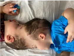 Bayi Kembar Siam Kepala Berhasil Dipisahkan Dibantu Pakai VR