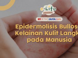 Ciri Penyakit Langka Epidermoliosis Bullosa, Kulit Serapuh Sayap Kupu-kupu Ciri Penyakit Langka Epidermoliosis Bullosa, Kulit Serapuh Sayap Kupu-kupu
