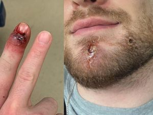 Curhat Pria Merana Gegara Cacar Monyet: Muncul Luka di Jari, Wajah, dan Mulut