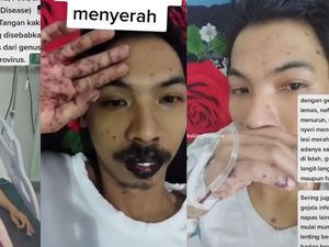 Viral Pria Ngaku Kena Flu Singapura, Bibir Hitam-Lenting di Seluruh Tubuh Viral Pria Ngaku Kena Flu Singapura, Bibir Hitam-Lenting di Seluruh Tubuh