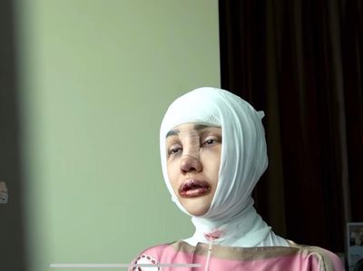 Potret Wajah Baru Lucinta Luna Pasca Operasi Ganti Kepala-Potong Leher