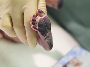 Kasus Bayi Lahir Kepala Putus di Indragiri Hilir Berakhir Damai