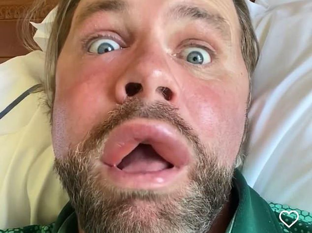 Bibir Digigit Lebah, Brian McFadden Eks Westlife Ngaku Jadi Keren Begini Bibir Digigit Lebah, Brian McFadden Eks Westlife Ngaku Jadi Keren Begini