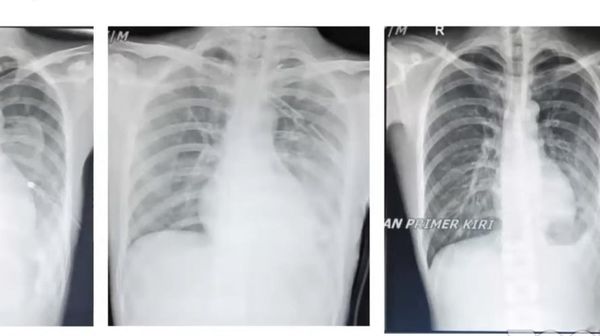 Yakin Mau Lanjut Ngevape? Ini Potret Pasien Terkapar di RS Gegara Paru Bocor