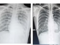 Ngeri! Begini Penampakan Paru-paru Pria RI yang Bocor gegara Rokok-Vape