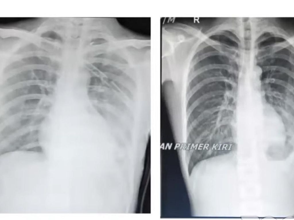Diyakini karena Rokok dan Vape, Paru-paru Pria 23 Tahun Ini Bocor Diyakini karena Rokok dan Vape, Paru-paru Pria 23 Tahun Ini Bocor