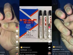 Viral Kuku Rusak Gegara Spidol Permanen, Dokter Kulit Ungkap Kemungkinannya