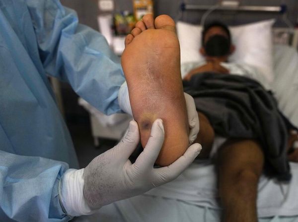 Penampakan Luka Cacar Monyet yang Menyerang Pasien di Peru