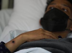 Terungkap! Pasien Pertama Cacar Monyet di RI Baru Pulang dari Eropa Barat