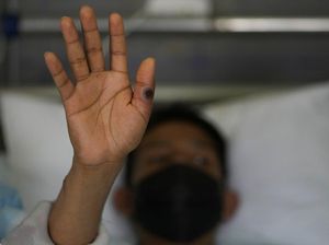 Bersilaju dengan Cacar Monyet