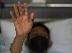 Bersilaju dengan Cacar Monyet