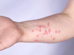 7 Obat Cacar Air Tradisional Alami agar Cepat Kering