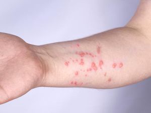 Satgas Mpox Sebut 90% Pasien di Jakarta Tertular karena LSL, Apa Itu? Satgas Mpox Sebut 90% Pasien di Jakarta Tertular karena LSL, Apa Itu?