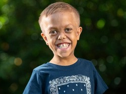 Bocah Australia yang Dibully Dwarfisme Ditawari Main Film Prekuel Mad Max