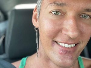 5 Fakta Pengakuan Bintang Porno Kena Cacar Monyet, Begini Gejala Hari ke Hari