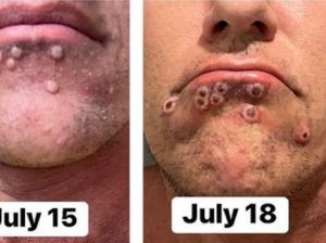 Gejala Cacar Monyet Mirip dengan Sifilis