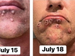 Gejala Cacar Monyet Mirip dengan Sifilis