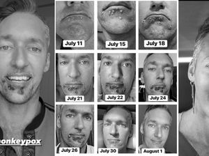 Bintang Porno Kena Cacar Monyet, Ini Penampakan Gejalanya dari Hari ke Hari