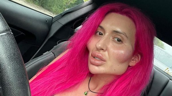 Potret Wajah Wanita Jadi Kotak Usai Suntik Filler, Mengerikan!