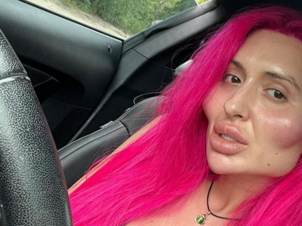 Potret Wajah Wanita Jadi Kotak Usai Suntik Filler, Mengerikan!