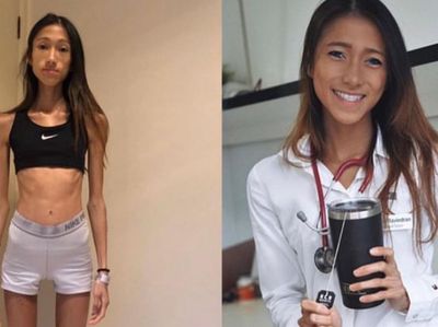 Penampilan Dokter Obsesi Kurus Berujung Anoreksia Parah, BB Cuma 30 Kg