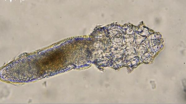 Ngeri! Ada Kutu yang Bersarang di Wajah Manusia