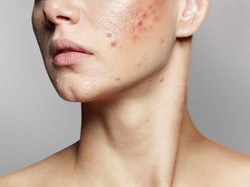 7 Makanan Ini Bantu Atasi Jerawat dan Bekasnya, Bikin Kulit Mulus!