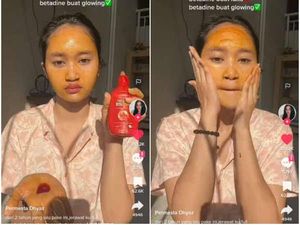 Viral di TikTok Pakai Betadine untuk Mengatasi Jerawat, Amankah?