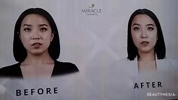 Miracle Aesthetic Clinic Luncurkan Treatment Sigma Code