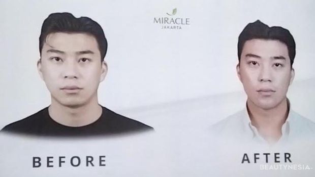 Miracle Aesthetic Clinic Luncurkan Treatment Sigma Code