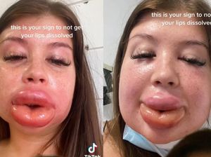 Viral Curhat Wanita Filler Bibir Berakhir Zonk, Sebut Rasanya Bak Mau Meledak