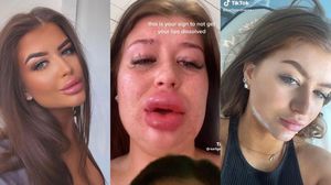 Potret Bibir Wanita Hampir Meletus Gara-gara Suntik Filler