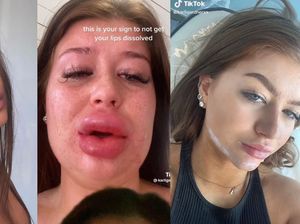 Potret Bibir Wanita Hampir Meletus Gara-gara Suntik Filler Potret Bibir Wanita Hampir Meletus Gara-gara Suntik Filler