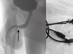 Kepo Berujung Kabel USB Nyangkut di Penis Bocah 15 Tahun, Begini Kronologinya