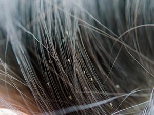 Kutu Kepala Ternyata Bisa Hidup di Rambut Bersih, Ini Penjelasannya