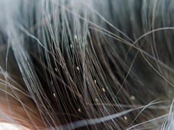 Kutu Kepala Ternyata Bisa Hidup di Rambut Bersih, Ini Penjelasannya