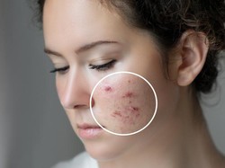 Benarkah Minum Susu Picu Jerawat? Ini Kata Dokter Kulit